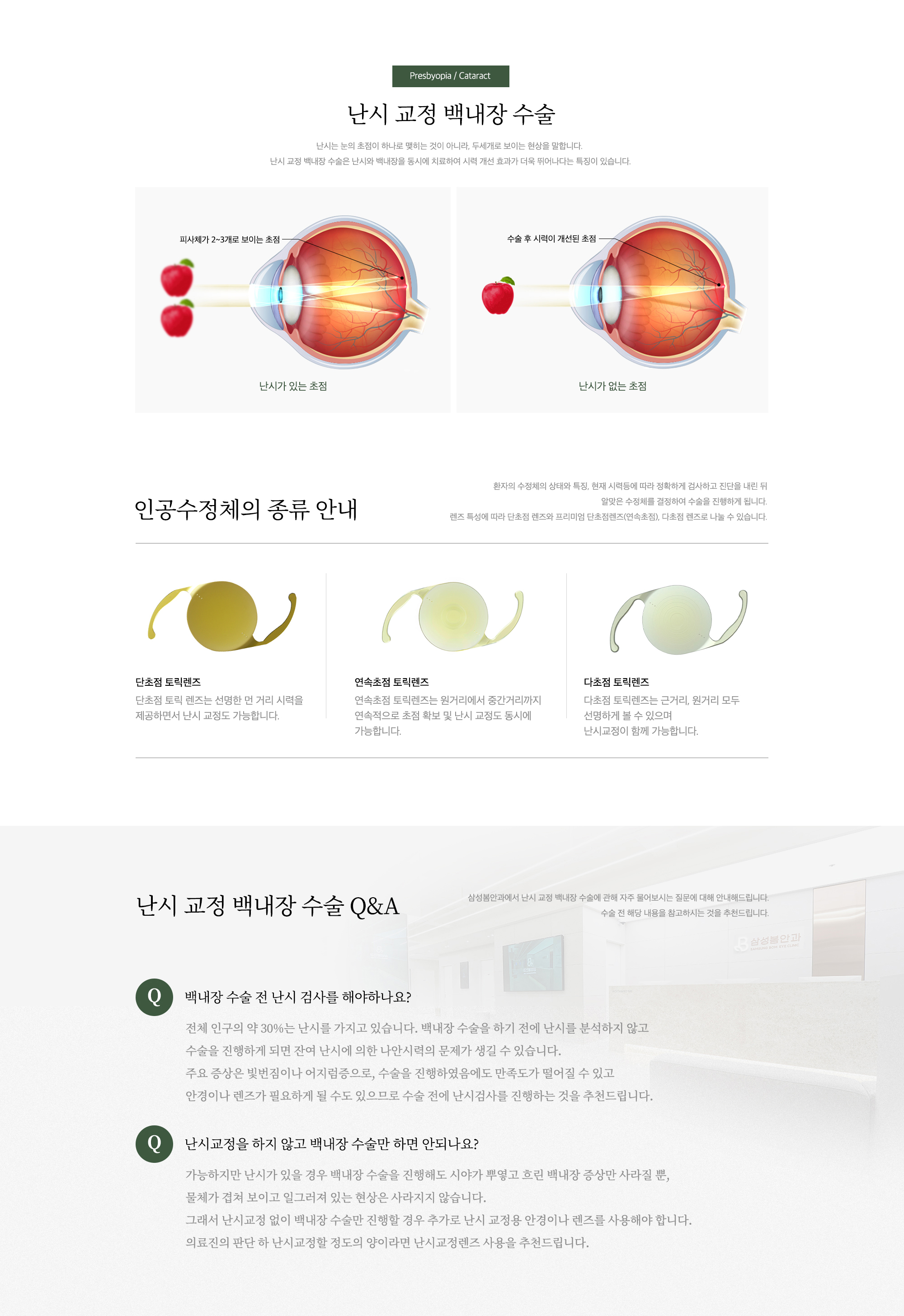 난시교정 백내장 수술