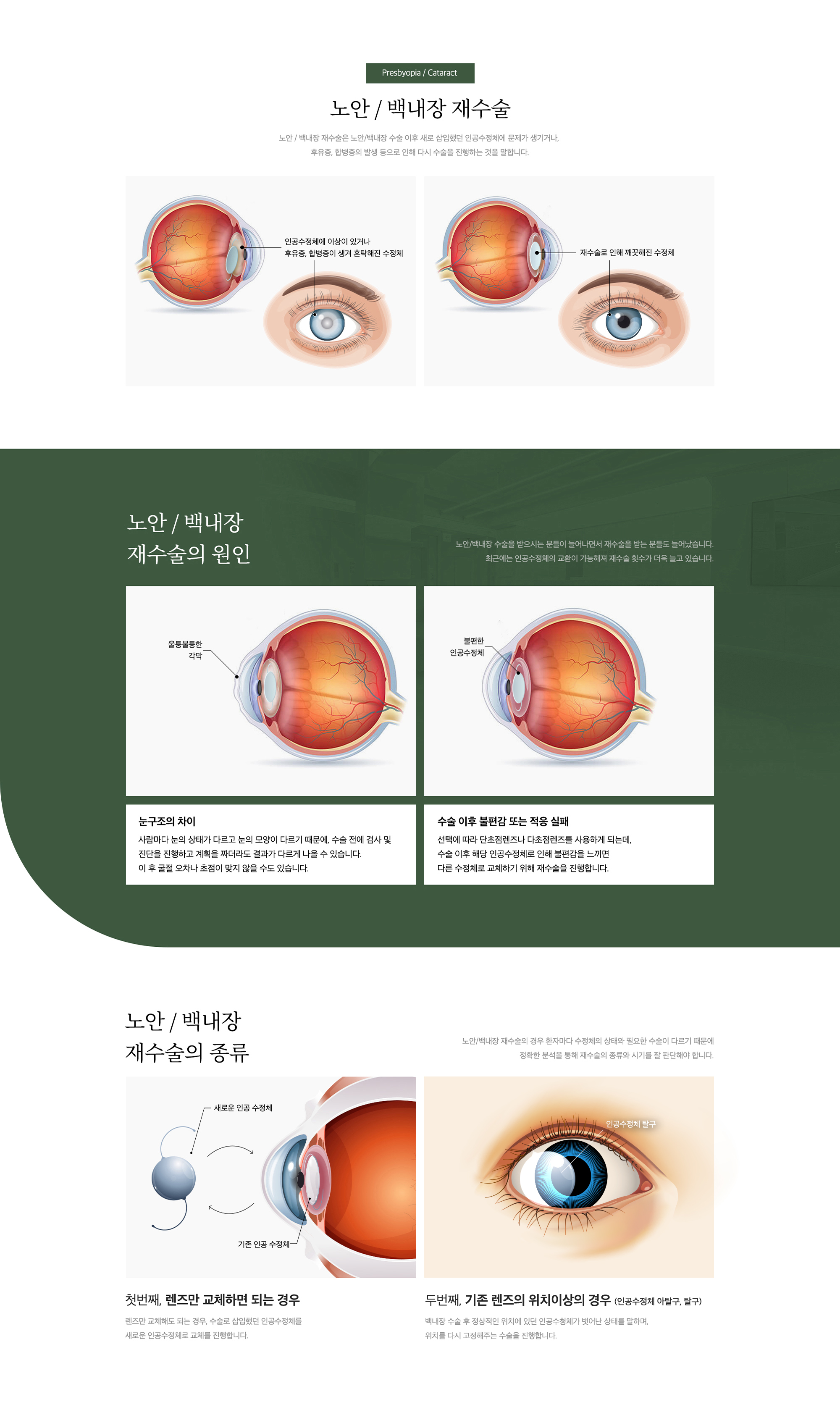 노안/백내장 재수술